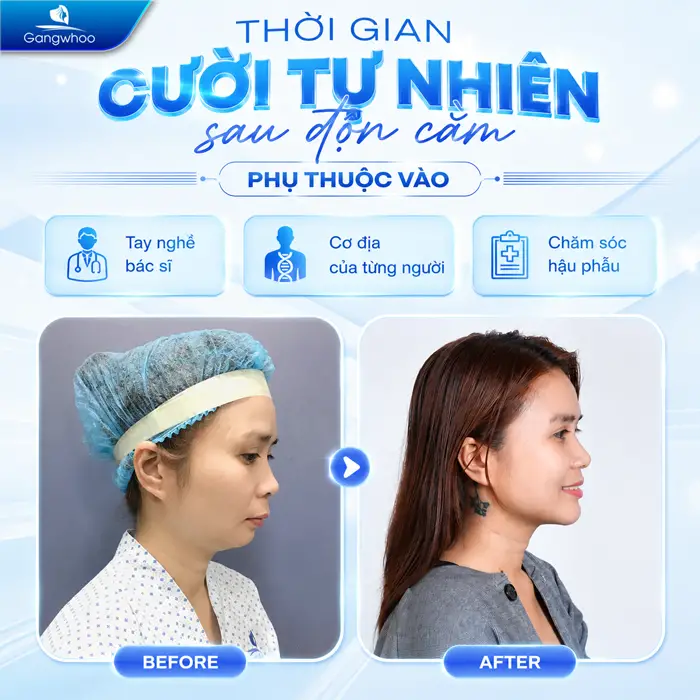 Độn Cằm Bao Lâu Cười Được? Những Yếu Tố Quyết Định