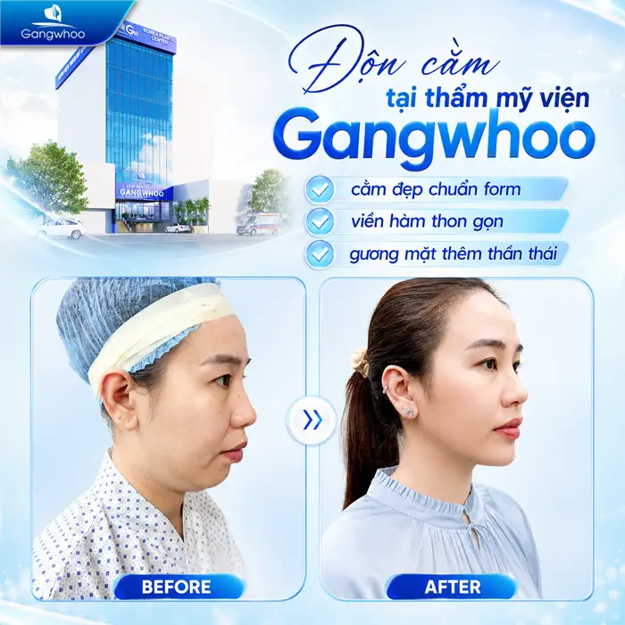 Độn Cằm Bao Lâu Cười Được? Những Yếu Tố Quyết Định
