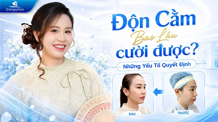 Độn Cằm Bao Lâu Cười Được? Những Yếu Tố Quyết Định