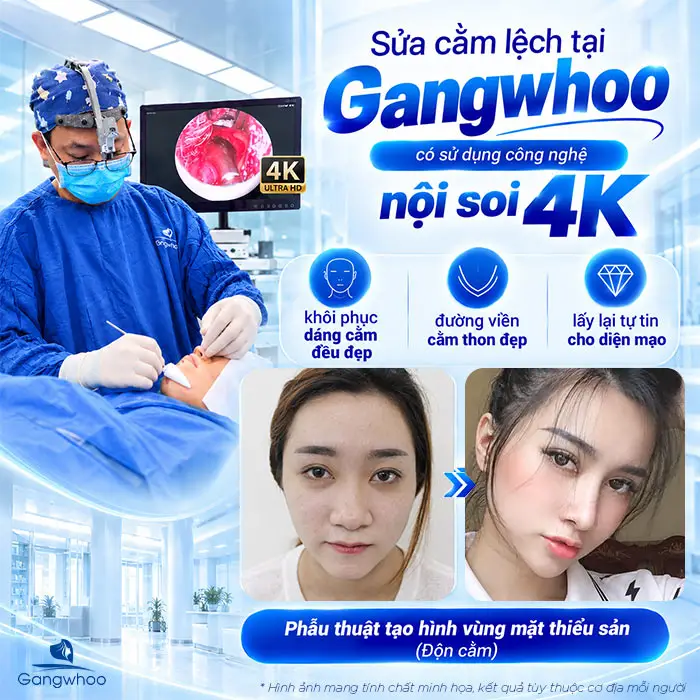 Độn Cằm Bị Lệch Phải Làm Sao? Nguyên Nhân Và Giải Pháp Khắc Phục Từ Chuyên Gia