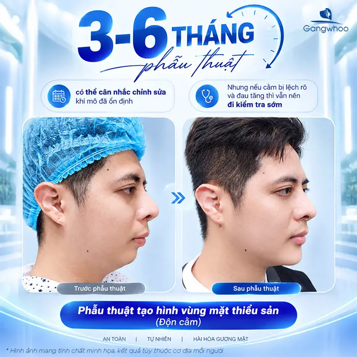 Độn Cằm Bị Lệch Phải Làm Sao? Nguyên Nhân Và Giải Pháp Khắc Phục Từ Chuyên Gia