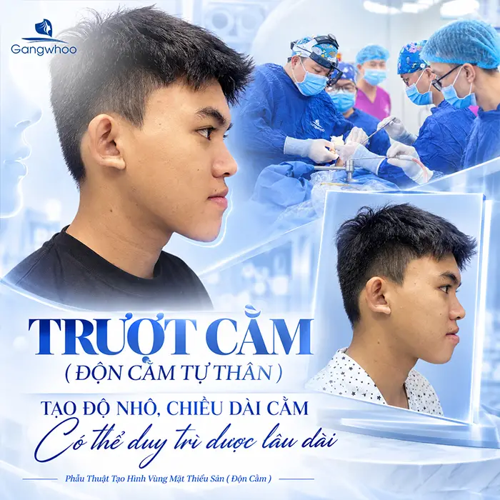 Độn Cằm Có Được Vĩnh Viễn Không? Góc Nhìn Toàn Diện Từ Chuyên Gia Thẩm Mỹ