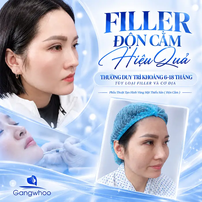 Độn Cằm Có Được Vĩnh Viễn Không? Góc Nhìn Toàn Diện Từ Chuyên Gia Thẩm Mỹ