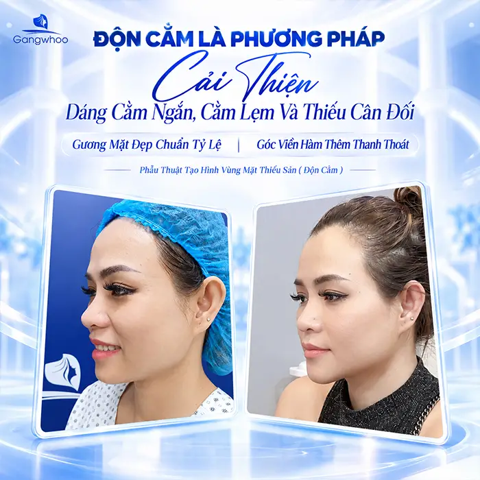 Độn Cằm Có Được Vĩnh Viễn Không? Góc Nhìn Toàn Diện Từ Chuyên Gia Thẩm Mỹ