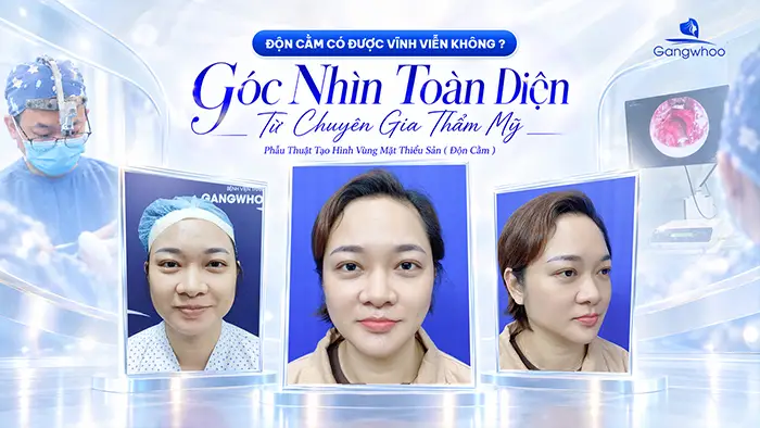Độn Cằm Có Được Vĩnh Viễn Không? Góc Nhìn Toàn Diện Từ Chuyên Gia Thẩm Mỹ