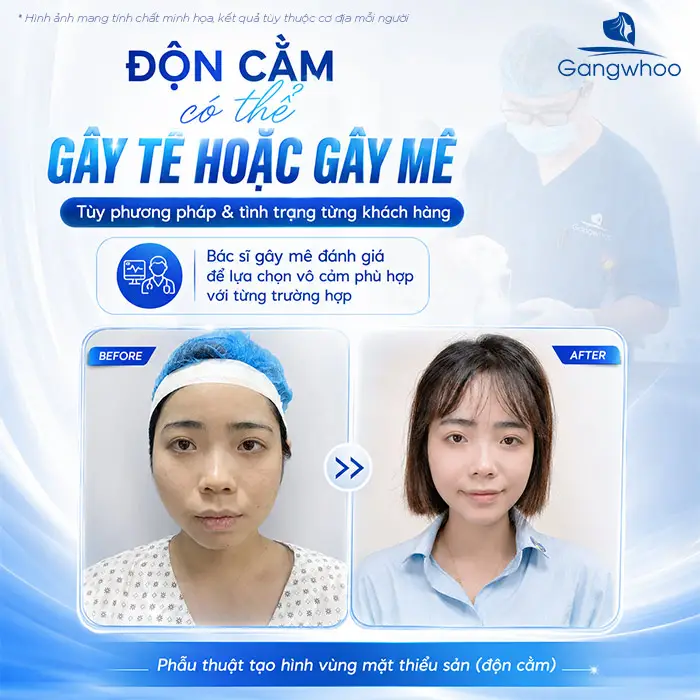 Độn Cằm Có Gây Mê Không? Giải Đáp Chuyên Môn
