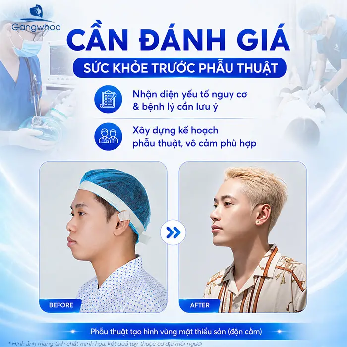 Độn Cằm Có Gây Mê Không? Giải Đáp Chuyên Môn
