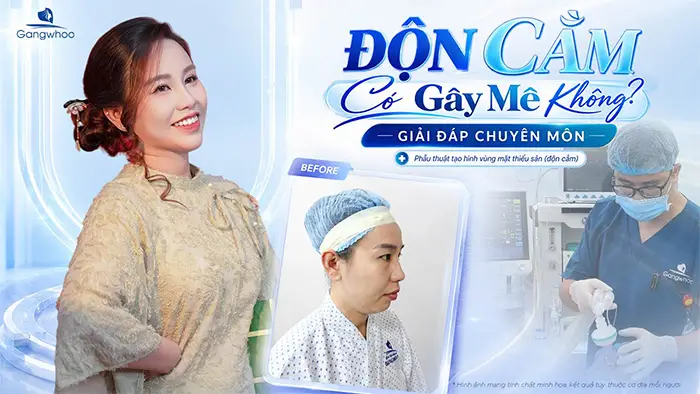 Độn Cằm Có Gây Mê Không? Giải Đáp Chuyên Môn