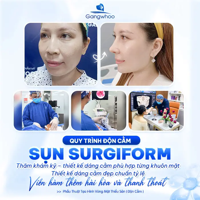 Độn Cằm Sụn Surgiform: Giải Pháp Tạo Dáng Cằm V-Line Chuẩn Y Khoa