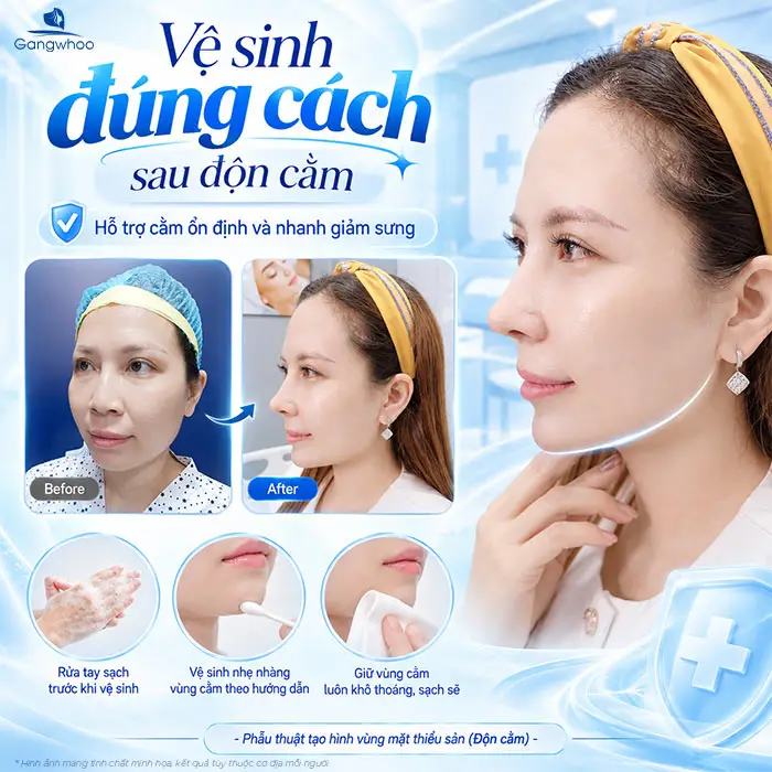 Độn Cằm Sụn Surgiform: Giải Pháp Tạo Dáng Cằm V-Line Chuẩn Y Khoa