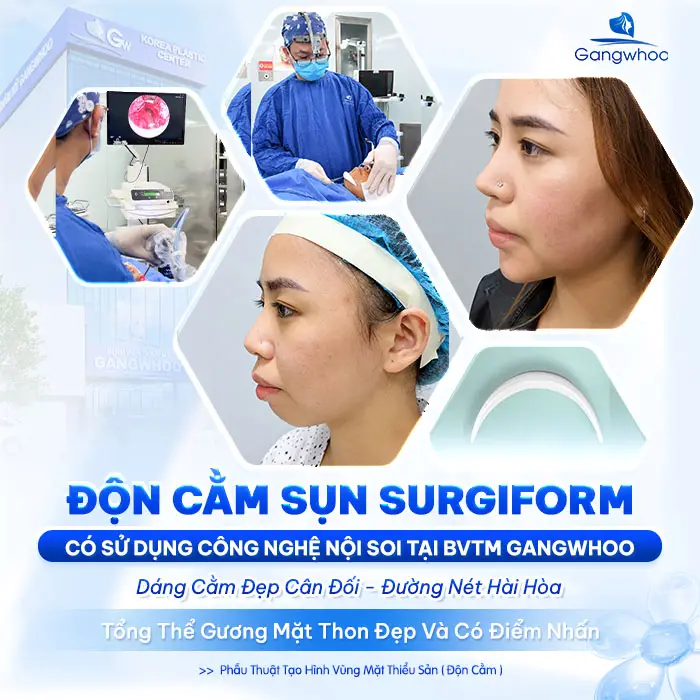 Độn Cằm Sụn Surgiform: Giải Pháp Tạo Dáng Cằm V-Line Chuẩn Y Khoa