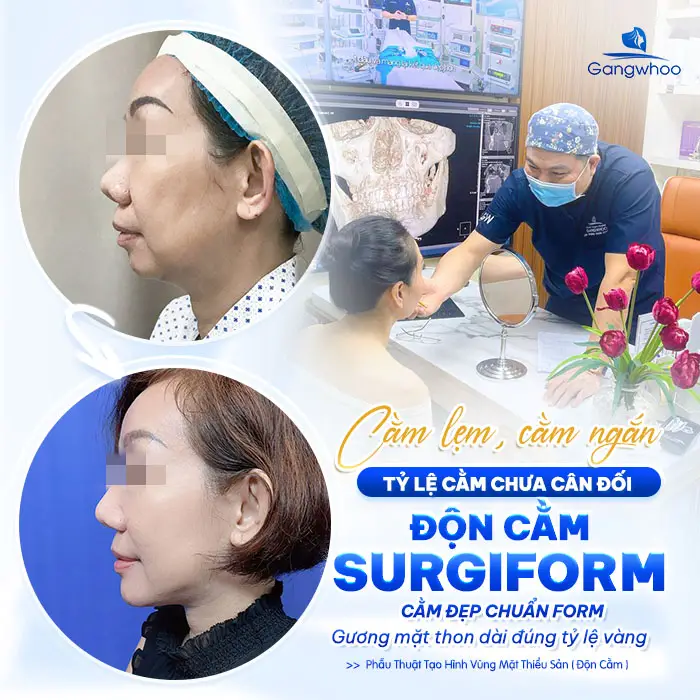 Độn Cằm Sụn Surgiform: Giải Pháp Tạo Dáng Cằm V-Line Chuẩn Y Khoa