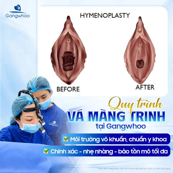 Vá Màng Trinh Được Không Khi Đã Quan Hệ Nhiều Lần? Giải Đáp Từ Chuyên Gia Gangwhoo