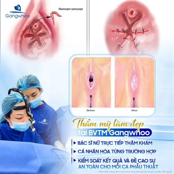 Vá Màng Trinh Được Không Khi Đã Quan Hệ Nhiều Lần? Giải Đáp Từ Chuyên Gia Gangwhoo