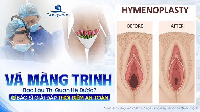 Vá Màng Trinh Bao Lâu Thì Quan Hệ Được? Giải Đáp Từ Chuyên Gia