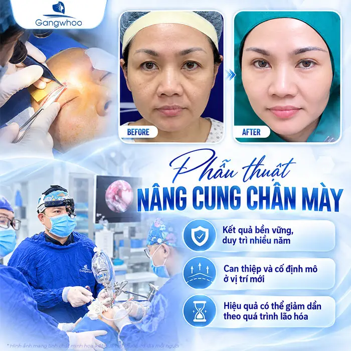 Nâng Cung Chân Mày Giữ Được Bao Lâu? Thời Gian Duy Trì Theo Từng Phương Pháp