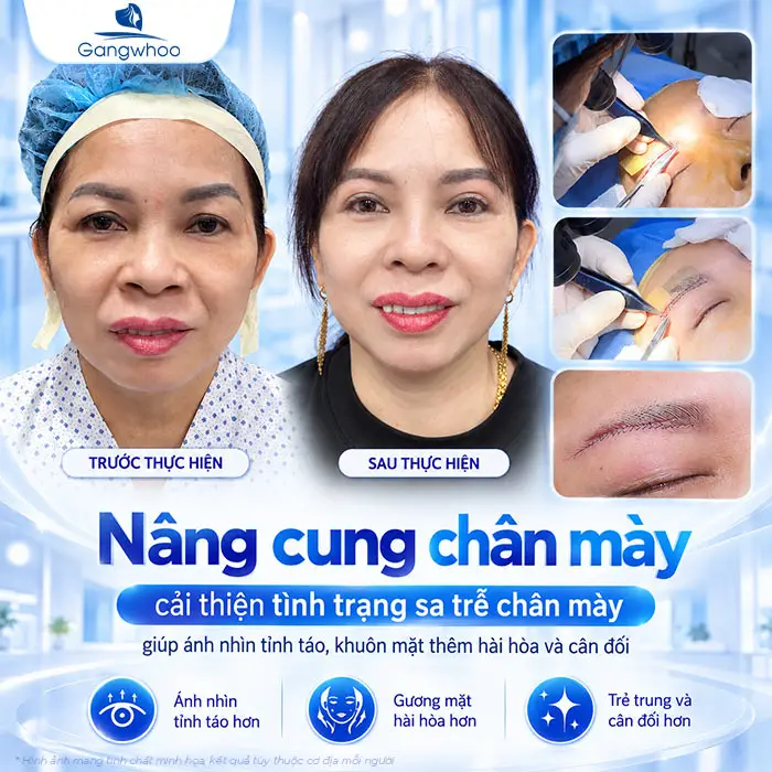 Nâng Cung Chân Mày Giữ Được Bao Lâu? Thời Gian Duy Trì Theo Từng Phương Pháp