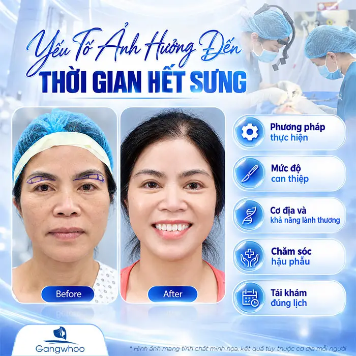 Nâng Cung Chân Mày Bao Lâu Thì Hết Sưng? Hướng Dẫn Chăm Sóc