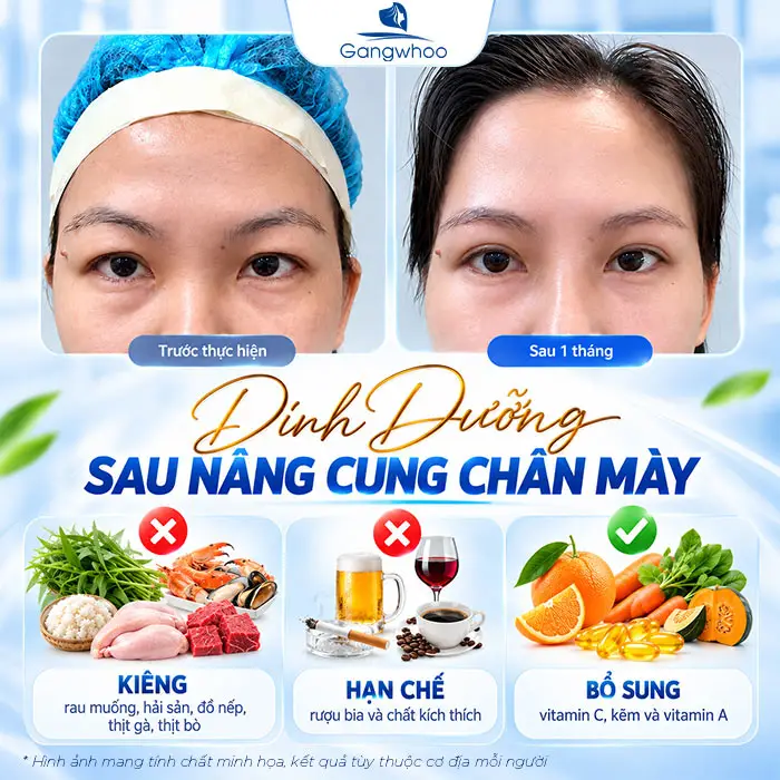 Nâng Cung Chân Mày Bao Lâu Thì Hết Sưng? Hướng Dẫn Chăm Sóc