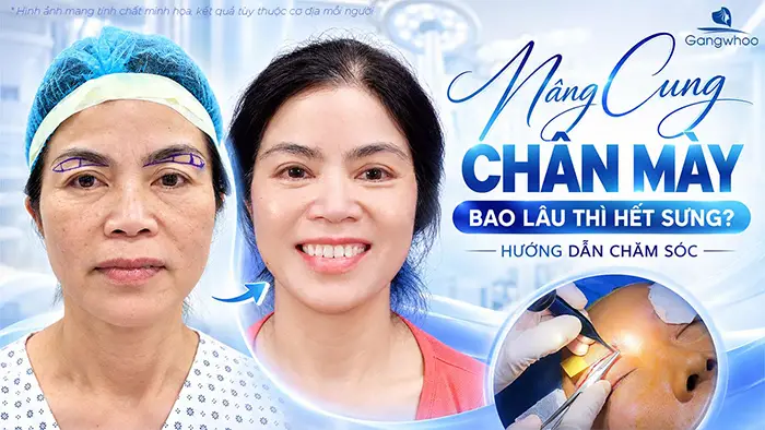 Nâng Cung Chân Mày Bao Lâu Thì Hết Sưng? Hướng Dẫn Chăm Sóc
