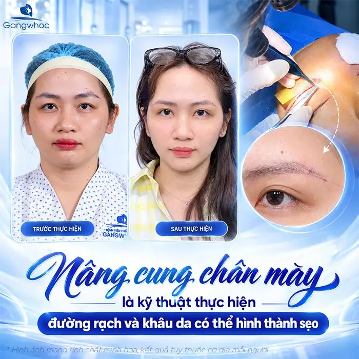 Nâng Cung Chân Mày Có Để Lại Sẹo Không? Bác Sĩ Nói Thật: Rất Nhiều Người Lo Lắng Vô Ích