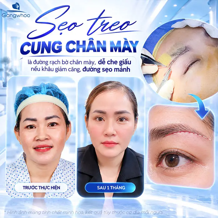 Nâng Cung Chân Mày Có Để Lại Sẹo Không? Bác Sĩ Nói Thật: Rất Nhiều Người Lo Lắng Vô Ích