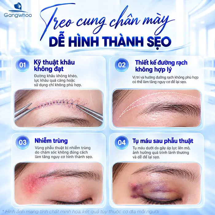 Nâng Cung Chân Mày Có Để Lại Sẹo Không? Bác Sĩ Nói Thật: Rất Nhiều Người Lo Lắng Vô Ích