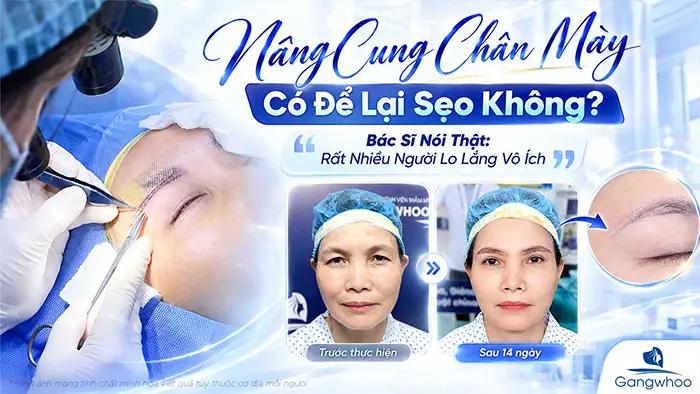Nâng Cung Chân Mày Có Để Lại Sẹo Không? Bác Sĩ Nói Thật: Rất Nhiều Người Lo Lắng Vô Ích