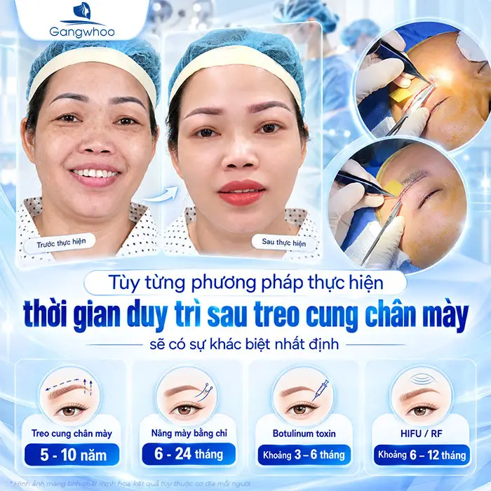 Nâng Cung Chân Mày Giữ Được Bao Lâu? Thời Gian Duy Trì Theo Từng Phương Pháp
