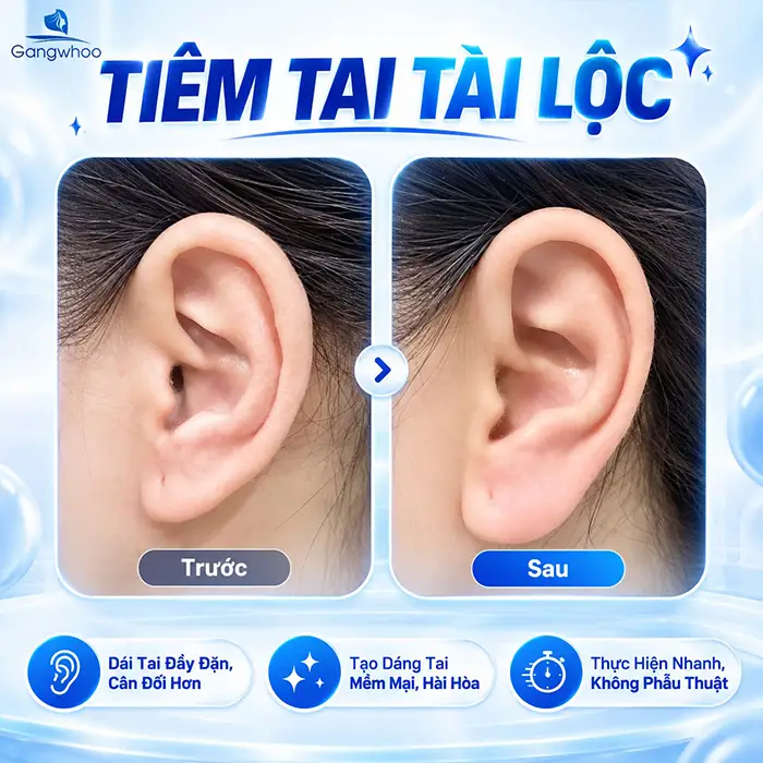 Tiêm Tai Tài Lộc Giá Bao Nhiêu? Bảng Gia Tiêm Filler Mới Nhất