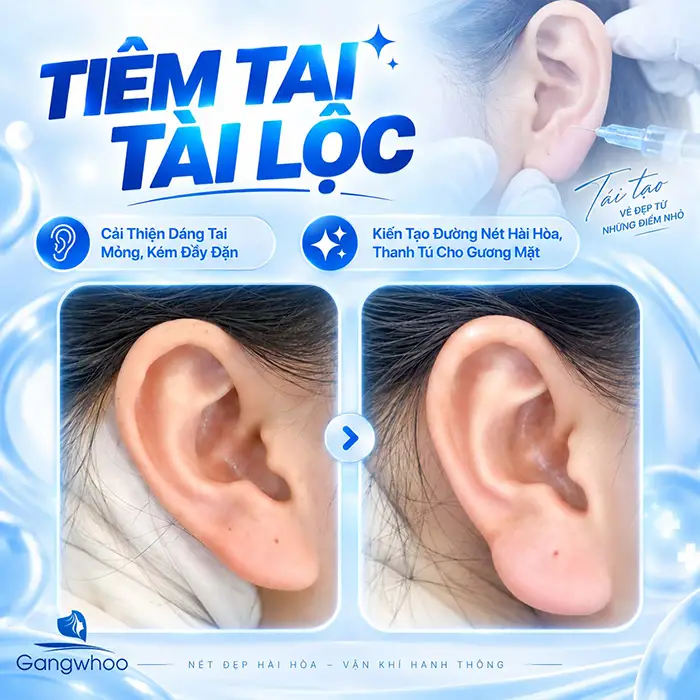 Tiêm Tai Tài Lộc Giá Bao Nhiêu? Bảng Gia Tiêm Filler Mới Nhất