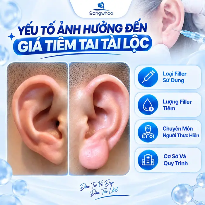 Tiêm Tai Tài Lộc Giá Bao Nhiêu? Bảng Gia Tiêm Filler Mới Nhất