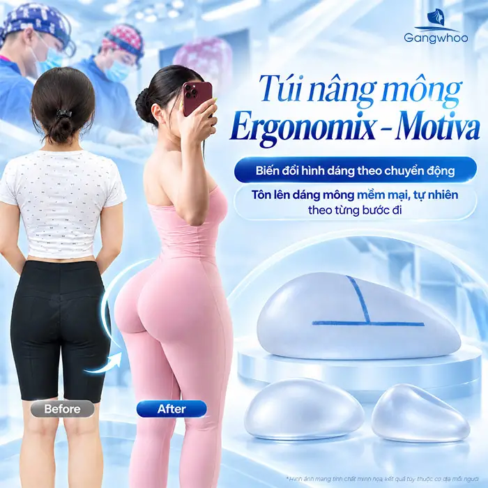 Top 4 Loại Túi Nâng Mông Tốt Nhất Hiện Nay – Đánh Giá Chuyên Khoa Từ Bác Sĩ