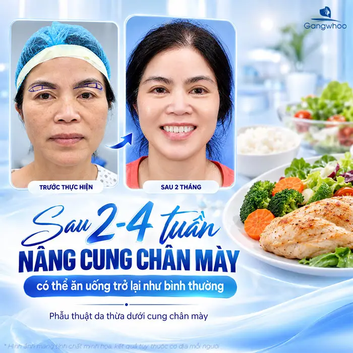 Nâng Cung Chân Mày Kiêng Ăn Gì? Danh Sách & Thời Gian Kiêng Chuẩn Y Khoa