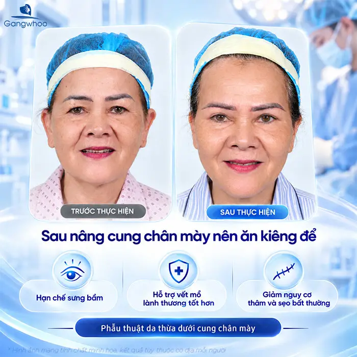 Nâng Cung Chân Mày Kiêng Ăn Gì? Danh Sách & Thời Gian Kiêng Chuẩn Y Khoa