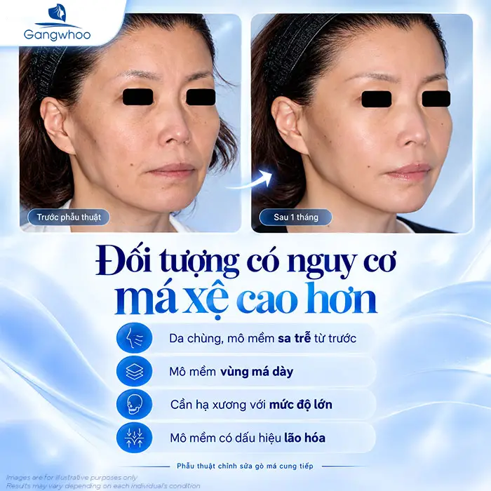 Hạ Gò Má Có Bị Xệ Mặt Không? Sự Thật Từ Góc Nhìn Chuyên Khoa Hàm Mặt