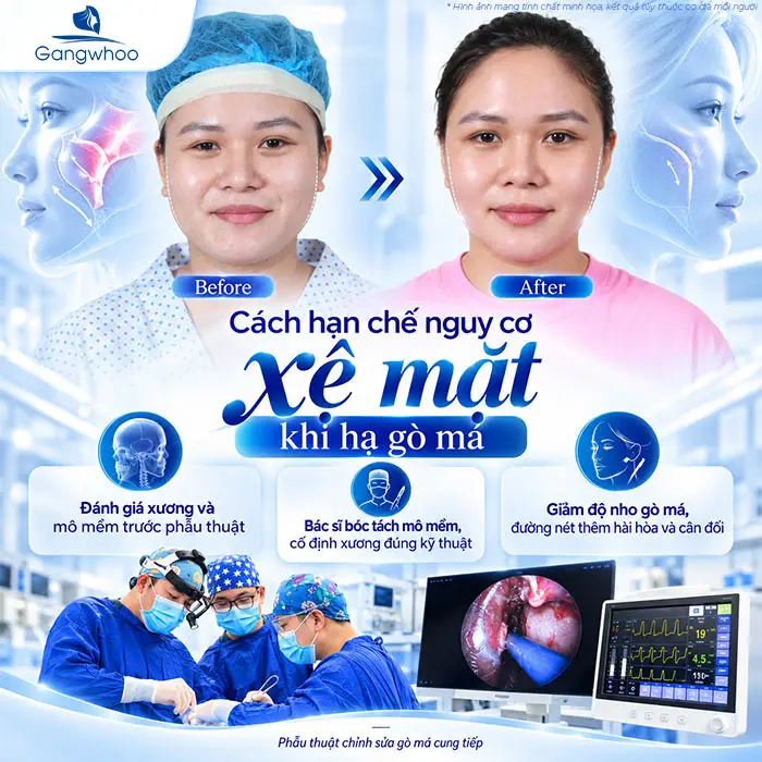 Hạ Gò Má Có Bị Xệ Mặt Không? Sự Thật Từ Góc Nhìn Chuyên Khoa Hàm Mặt