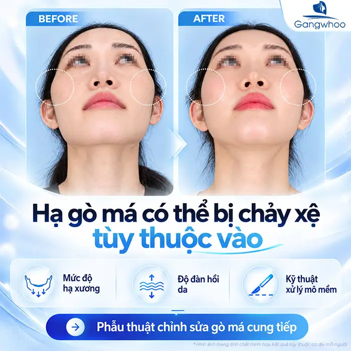 Hạ Gò Má Có Bị Xệ Mặt Không? Sự Thật Từ Góc Nhìn Chuyên Khoa Hàm Mặt