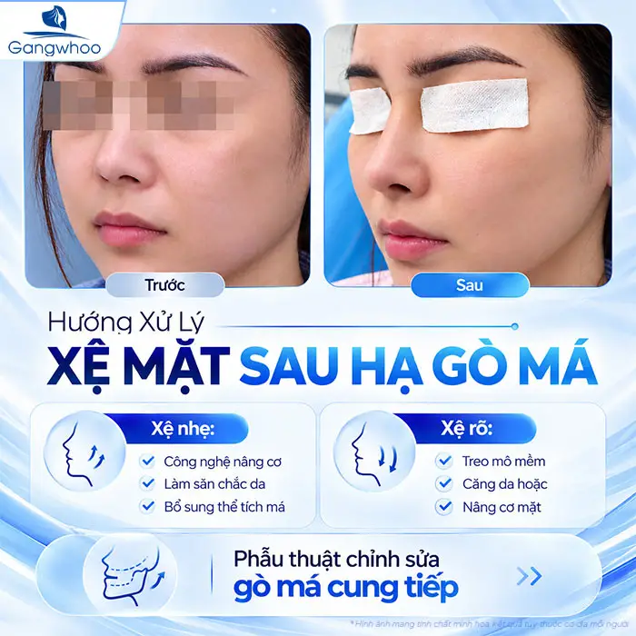Hạ Gò Má Có Bị Xệ Mặt Không? Sự Thật Từ Góc Nhìn Chuyên Khoa Hàm Mặt