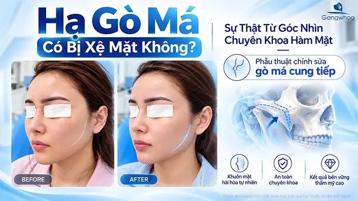 Hạ Gò Má Có Bị Xệ Mặt Không? Sự Thật Từ Góc Nhìn Chuyên Khoa Hàm Mặt